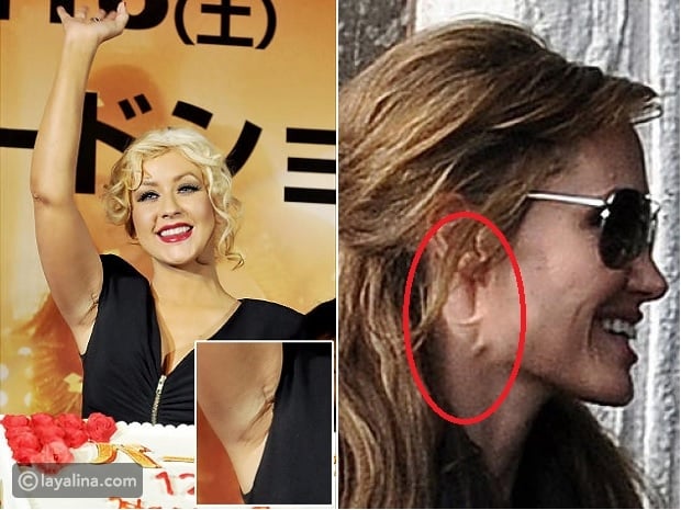 بين الحوادث وعمليات تجميل فاشلة: صور مشاهير يحملون ندوب بعضها ترونها لأول مرة