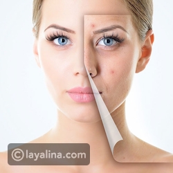 أفضل كريم لحب الشباب من أهم ماركات العناية بالبشرة ليالينا