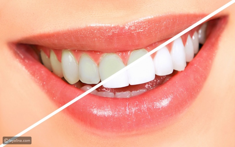 تبييض الأسنان بالليزر: كيفية تطبيقه وأثره على أسنانك