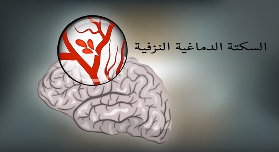 أسباب وأعراض السكتة الدماغية ليالينا