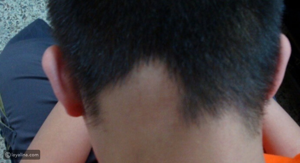 مرض الثعلبة alopecia areata أسبابه وأعراضه وطرق علاجه ليالينا