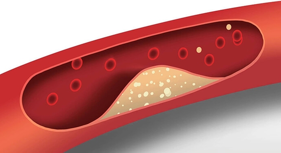 ارتفاع ضغط الدم الأعراض والأسباب
