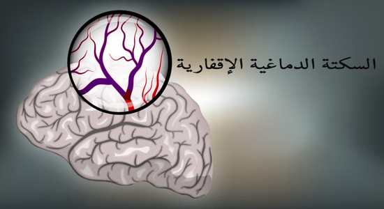 أسباب وأعراض السكتة الدماغية ليالينا