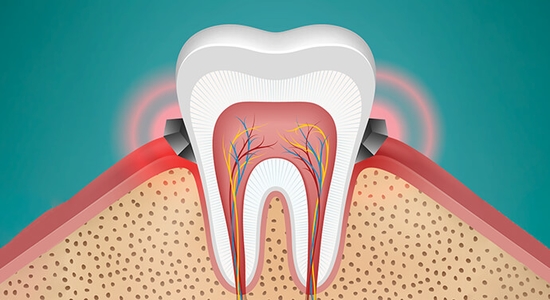 أسباب التهاب اللثة وطرق علاجها ليالينا