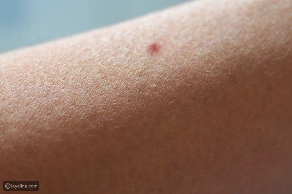 كيفية التخلص من الشعر تحت الجلد والنقط السوداء ليالينا